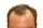 Hair Loss 2