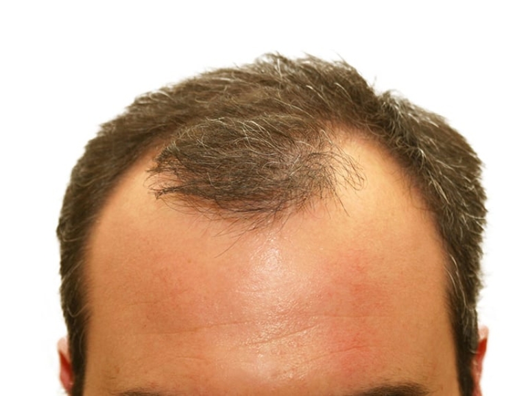 Hair Loss 2
