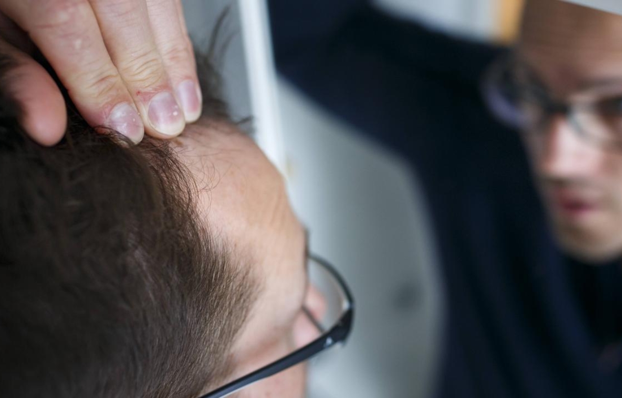 Hair Loss in Men