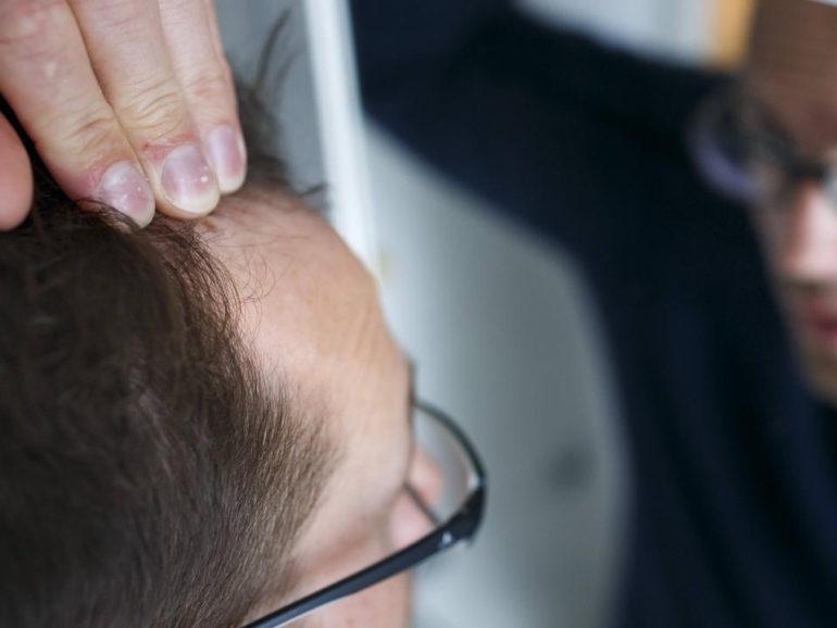 Hair Loss in Men