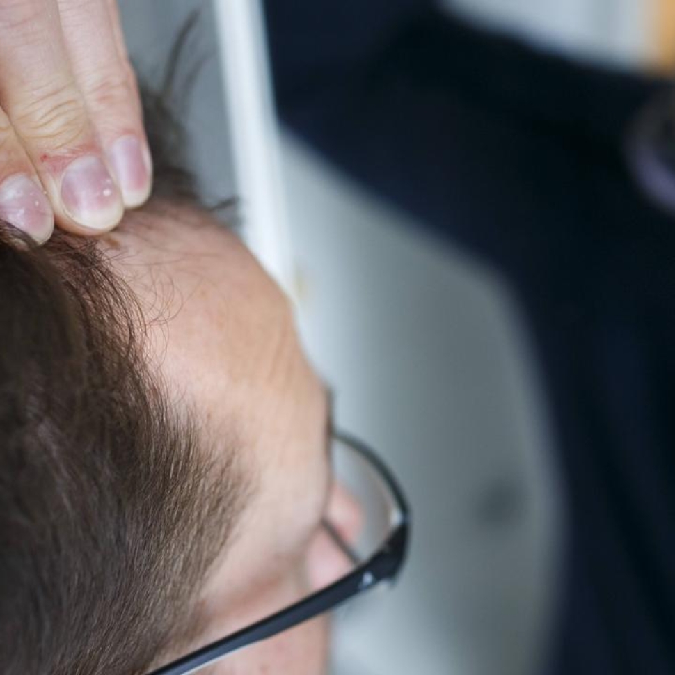 Hair Loss in Men